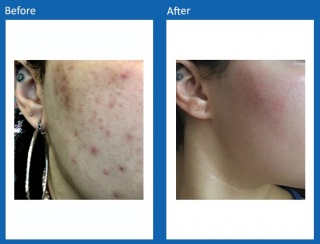 Acne-Before-and-After-1