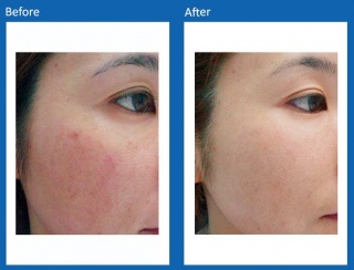 Acne-Before-and-After-2