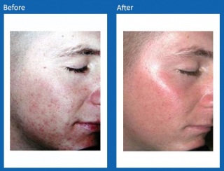 Acne-Before-and-After-3