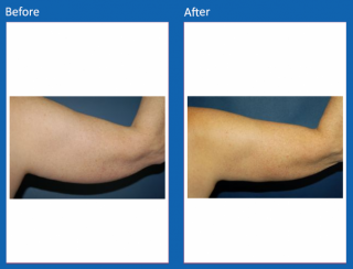 arm-lift-1