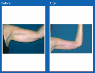 arm-lift-10