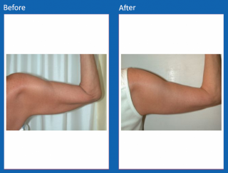 arm-lift-11