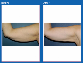 arm-lift-2