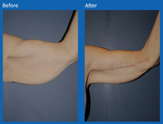 arm-lift-3