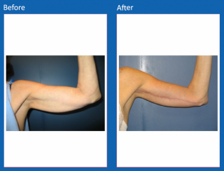 arm-lift-4