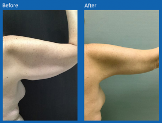 arm-lift-6