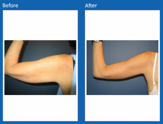arm-lift-7