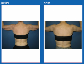 arm-lift-8