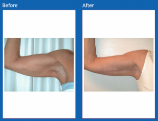 arm-lift-9