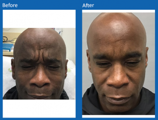 botox-1