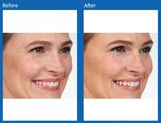 botox-10