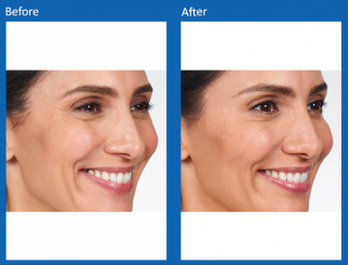botox-12