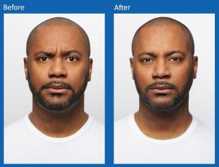 botox-2