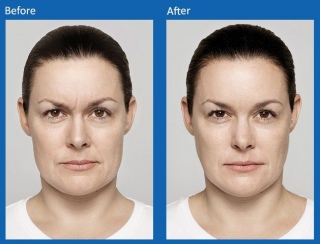 botox-3
