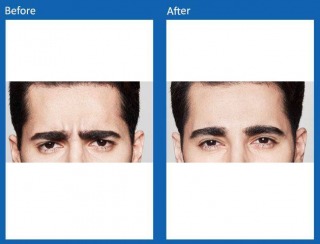 botox-4