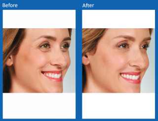 botox-6
