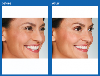 botox-7