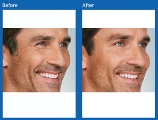 botox-8
