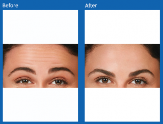 botox-9