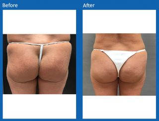 brazilian-butt-lift-6