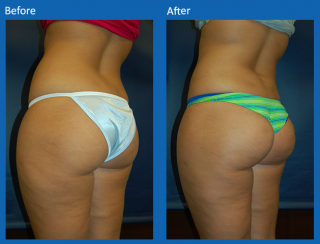 brazilian-butt-lift-7