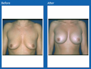 breast-augmentation-1