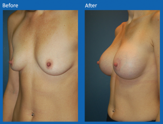 breast-augmentation-10