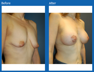 breast-augmentation-11