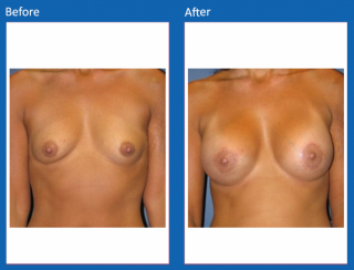 breast-augmentation-12