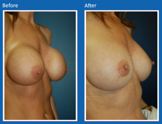 breast-augmentation-13