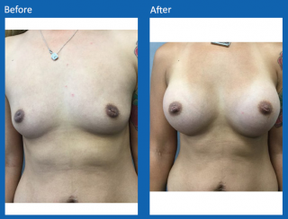 breast-augmentation-14