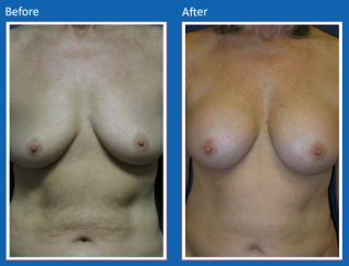 breast-augmentation-15