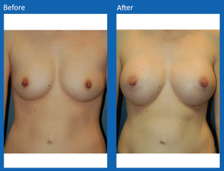 breast-augmentation-16