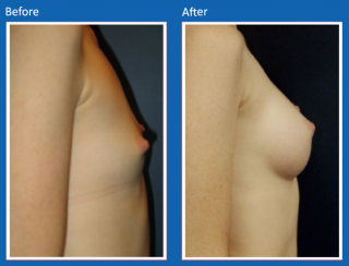 breast-augmentation-17