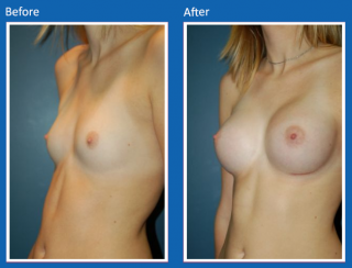 breast-augmentation-18