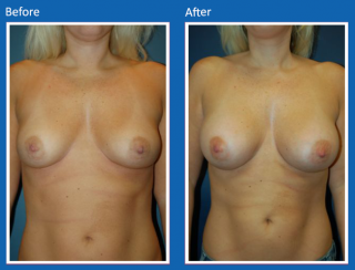 breast-augmentation-2
