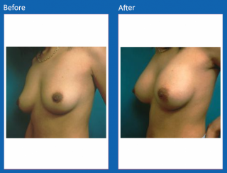 breast-augmentation-20