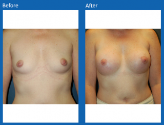 breast-augmentation-21