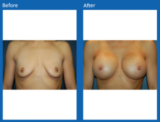 breast-augmentation-22