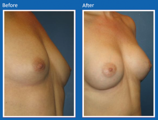 breast-augmentation-23
