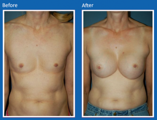 breast-augmentation-24