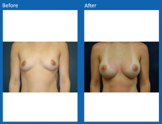 breast-augmentation-25