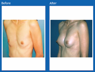 breast-augmentation-26