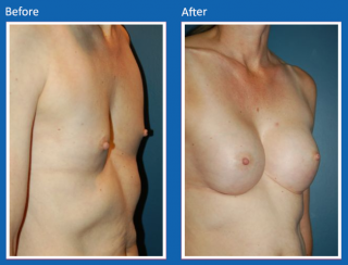 breast-augmentation-27