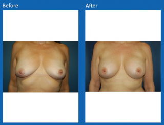 breast-augmentation-28