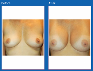 breast-augmentation-29