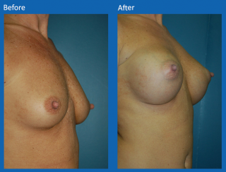 breast-augmentation-3