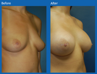 breast-augmentation-30