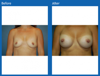 breast-augmentation-31