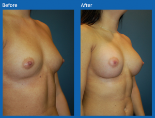 breast-augmentation-32